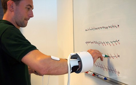 STIL - Anti Tremor Orthosis Device